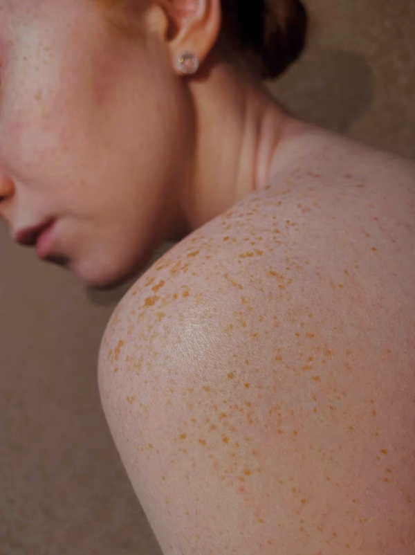 Facial SOS: Why is my face breaking out after my facial?
